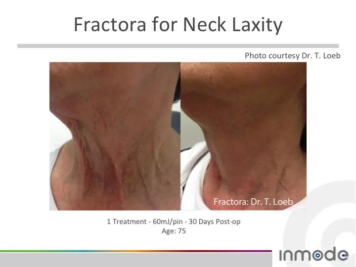No More Turkey Necks – Introducing Fractora!