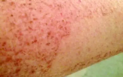 Sick of age spots? Lumecca IPL is the Answer.