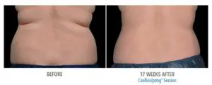 CoolSculpting Before After Pictures in Snellville, GA