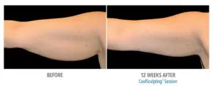 CoolSculpting Before After Pictures in Snellville, GA