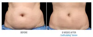 CoolSculpting Before After Pictures in Snellville, GA