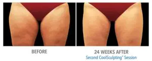 CoolSculpting Before After Pictures in Snellville, GA