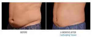 CoolSculpting Before After Pictures in Snellville, GA