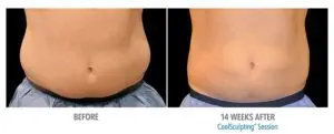 CoolSculpting Before After Pictures in Snellville, GA