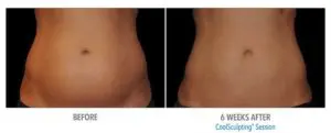 CoolSculpting Before After Pictures in Snellville, GA