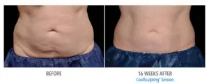 CoolSculpting Before After Pictures in Snellville, GA