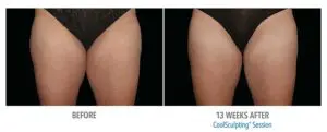 CoolSculpting Before After Pictures in Snellville, GA
