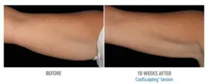 CoolSculpting Before After Pictures in Snellville, GA