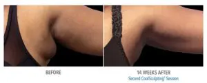 CoolSculpting Before After Pictures in Snellville, GA