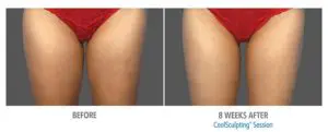 CoolSculpting Before After Pictures in Snellville, GA