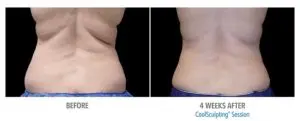 CoolSculpting Before After Pictures in Snellville, GA