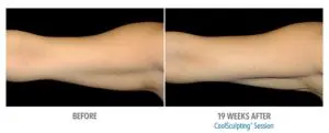 CoolSculpting Before After Pictures in Snellville, GA