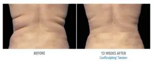 CoolSculpting Before After Pictures in Snellville, GA