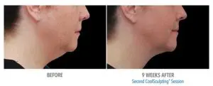 CoolSculpting Before After Pictures in Snellville, GA