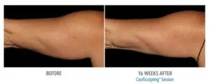 CoolSculpting Before After Pictures in Snellville, GA