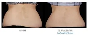 CoolSculpting Before After Pictures in Snellville, GA