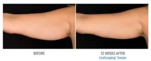 CoolSculpting Before After Pictures in Snellville, GA