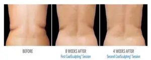 CoolSculpting Before After Pictures in Snellville, GA