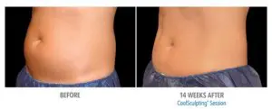 CoolSculpting Before After Pictures in Snellville, GA