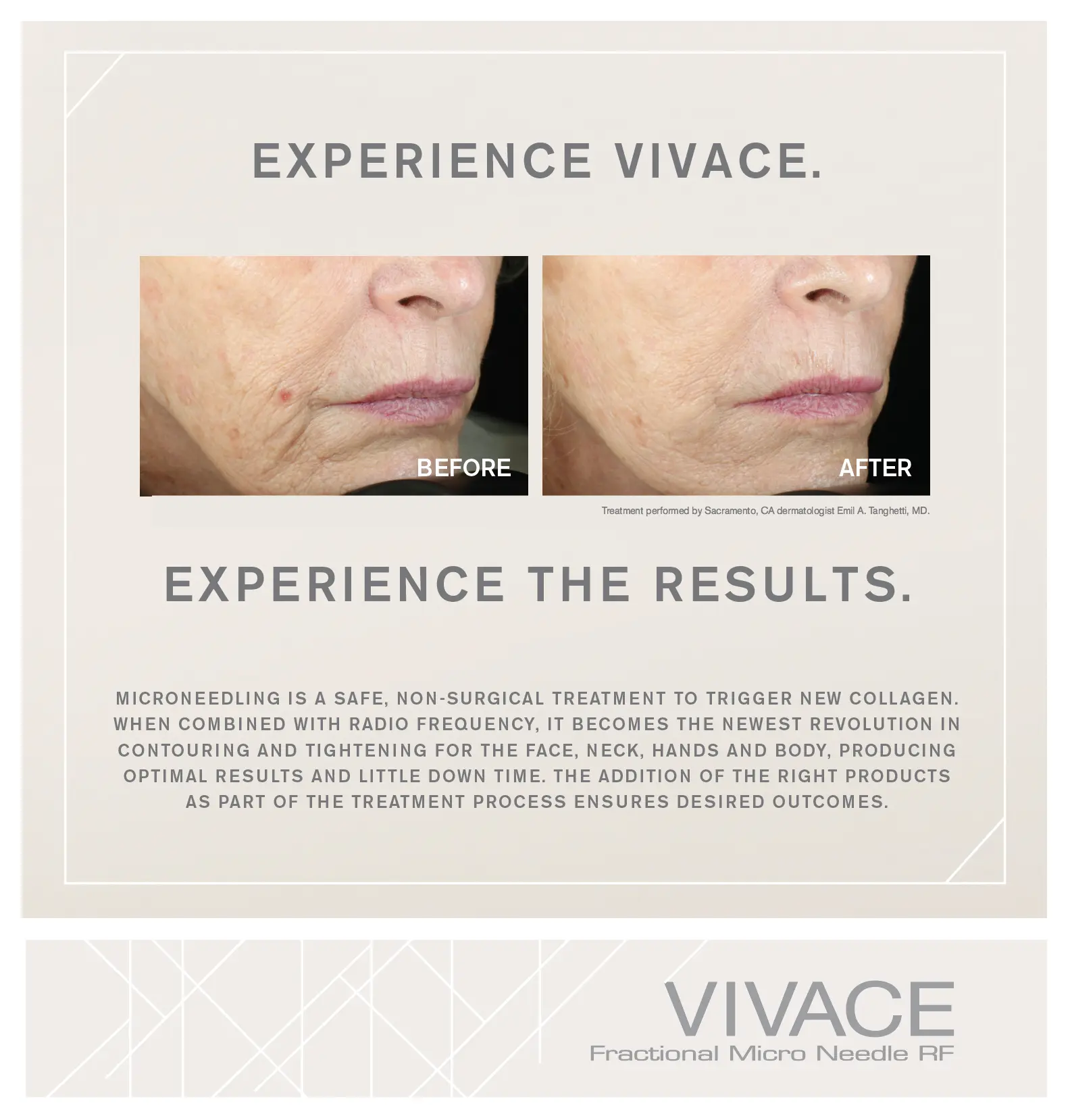 Vivace™ Fractional Micro Needle RF in Snellville, GA