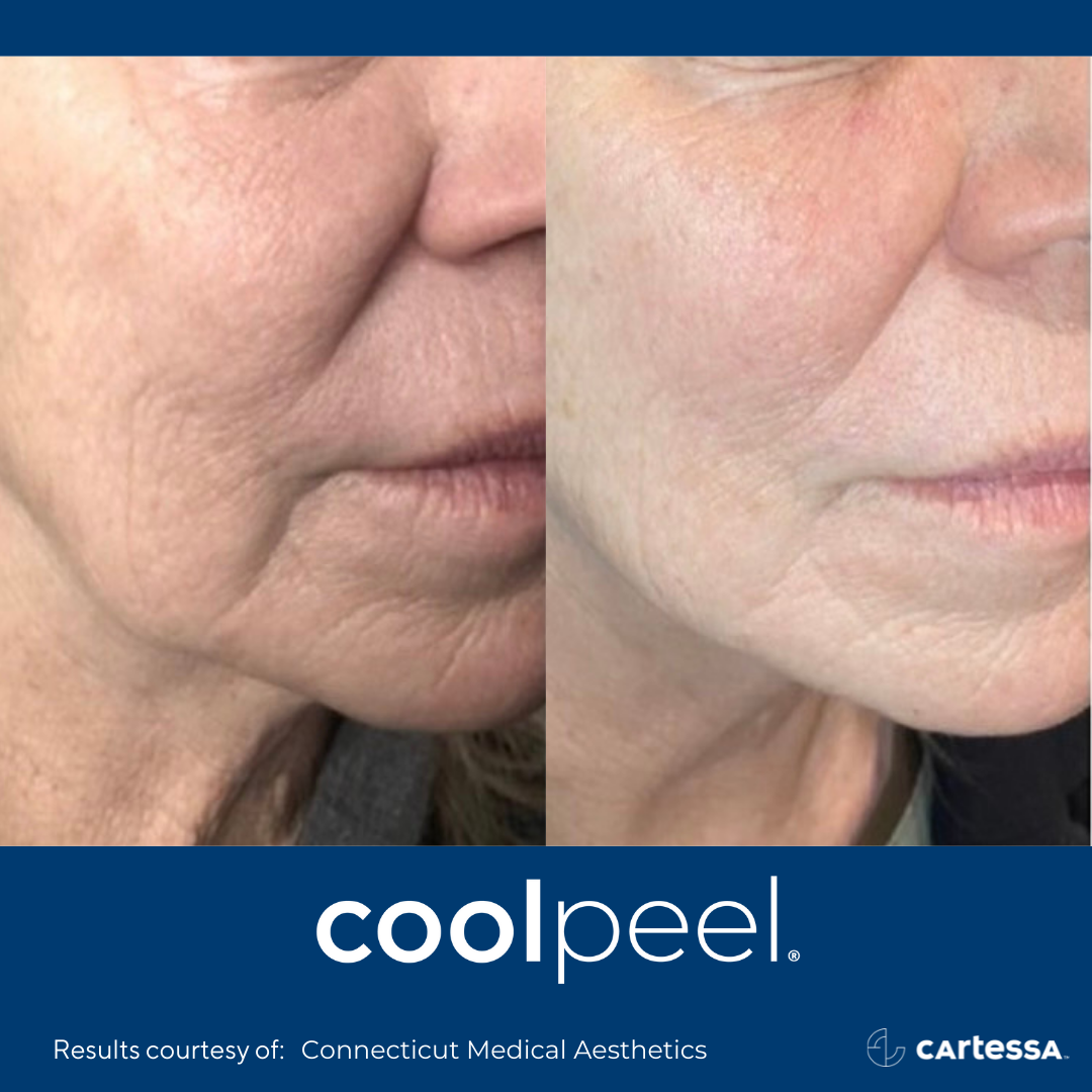 CoolPeel® in Snellville, GA