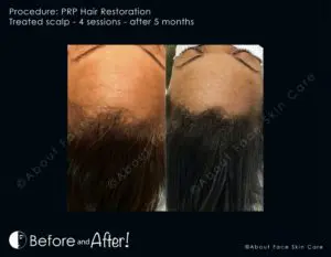 PRP Hair Restoration Before and After Pictures Snellville and Dacula, GA