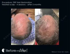 PRP Hair Restoration Before and After Pictures Snellville and Dacula, GA