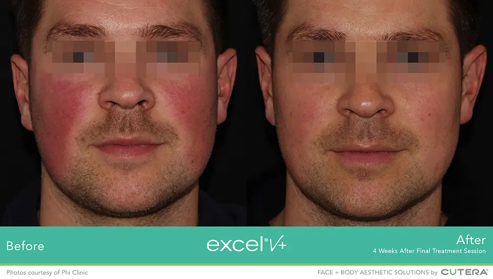Excel V+ by Cutera® Before and After Pictures Snellville and Dacula, GA