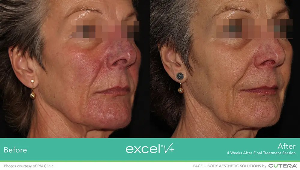 Excel V+ by Cutera® Before and After Pictures Snellville and Dacula, GA