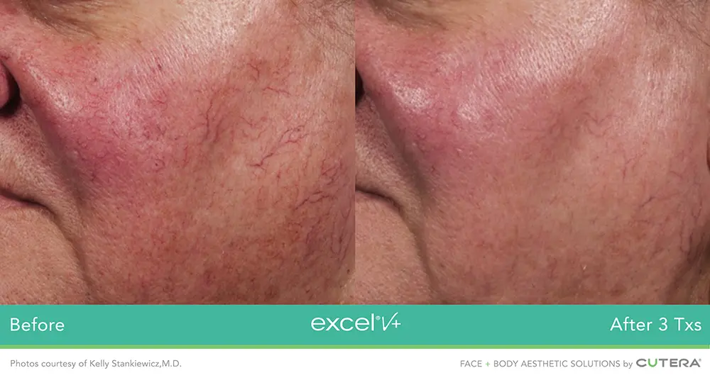 Excel V+ by Cutera® Before and After Pictures Snellville and Dacula, GA