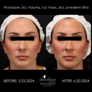 Before & After Photo after dermal HA Fillers 