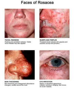 Rosacea symptoms including facial redness, acne-like bumps, thickened skin on the nose, and eye irritation