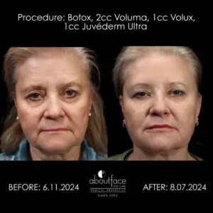 Before and after Botox and dermal filler treatment with Voluma, Volux, and Juvederm Ultra showing facial rejuvenation, smoother skin, improved jawline definition, and restored facial volume at About Face Skin Care.
