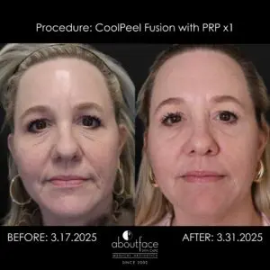 CoolPeel Fusion with PRP before and after showing facial skin rejuvenation after one treatment