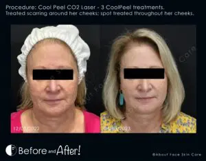 CoolPeel CO2 laser before and after showing improvement in cheek scarring and skin texture after three treatments