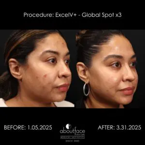 Excel V+ Global laser before and after showing improvement in facial redness after three spot treatments