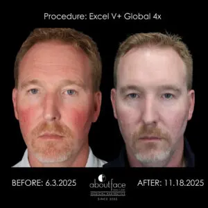 Excel V+ Global laser before and after showing reduced facial redness after four treatments
