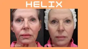 Helix DEKA laser before and after showing facial skin resurfacing and rejuvenation results