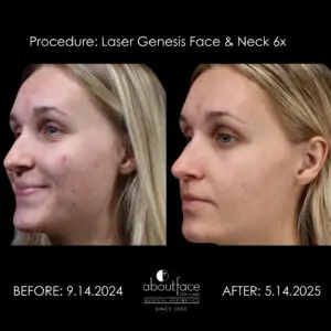 Laser Genesis before and after showing improved facial redness and skin tone after six face and neck treatments