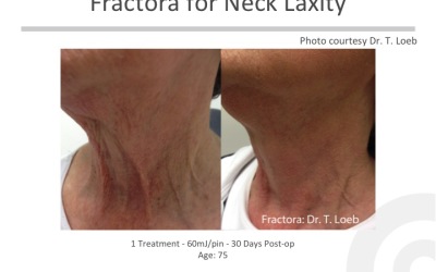 No More Turkey Necks – Introducing Fractora!