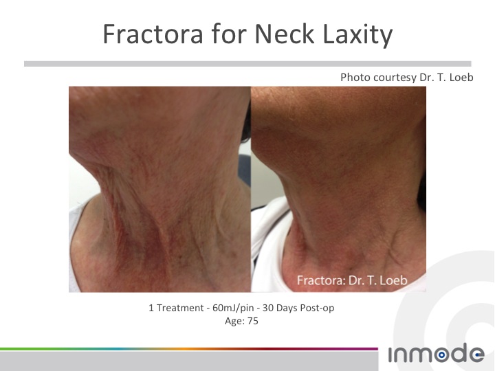 No More Turkey Necks – Introducing Fractora!