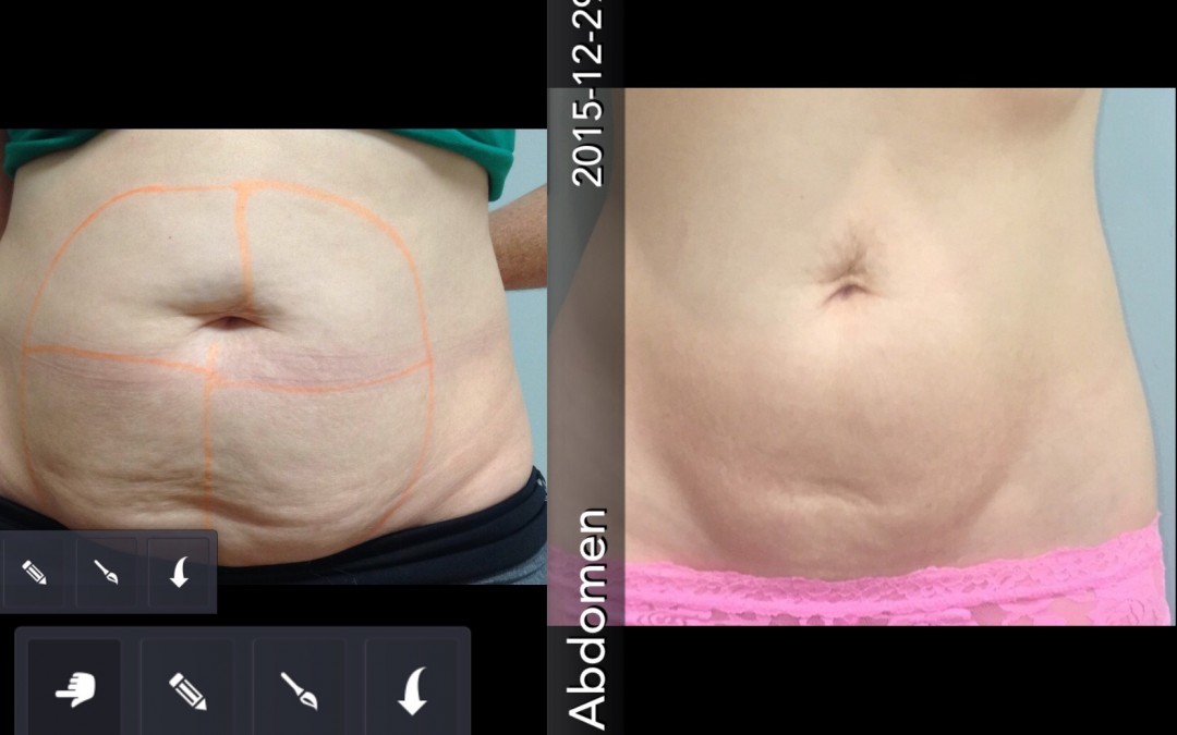 Body FX Before and After Pictures Snellville and Dacula, GA