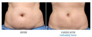 CoolSculpting Before After Pictures in Snellville, GA