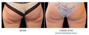 CoolSculpting Before After Pictures in Snellville, GA