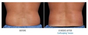 CoolSculpting Before After Pictures in Snellville, GA