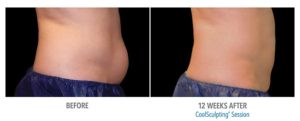 CoolSculpting Before After Pictures in Snellville, GA