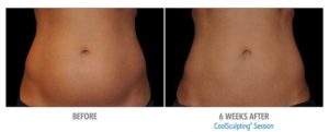 CoolSculpting Before After Pictures in Snellville, GA