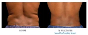 CoolSculpting Before After Pictures in Snellville, GA