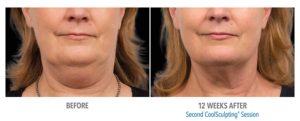 CoolSculpting Before After Pictures in Snellville, GA