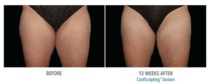 CoolSculpting Before After Pictures in Snellville, GA